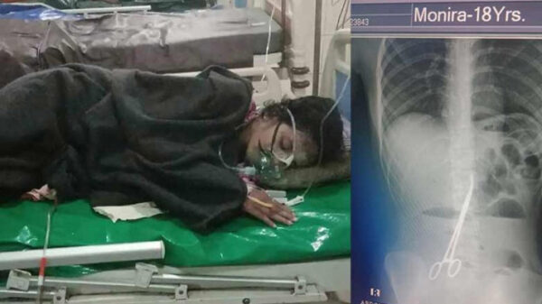 পেটে কাঁচি রেখেই সেলাই, ৬৪৮ দিন পর অপসারণ